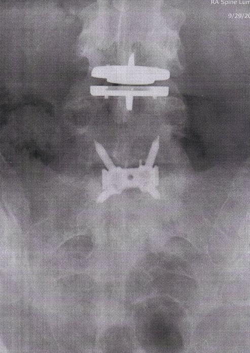 This x-ray was taken 6 weeks post-op. Spinal fusion with instrumentation L4/5-L5/S1, disc replacement L3/4